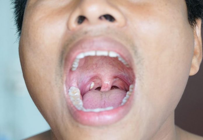 Uneven Tonsils