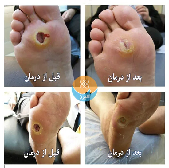 درمان زخم در کلینیک تخصصی زخم پای دیابتی البرز در کرج